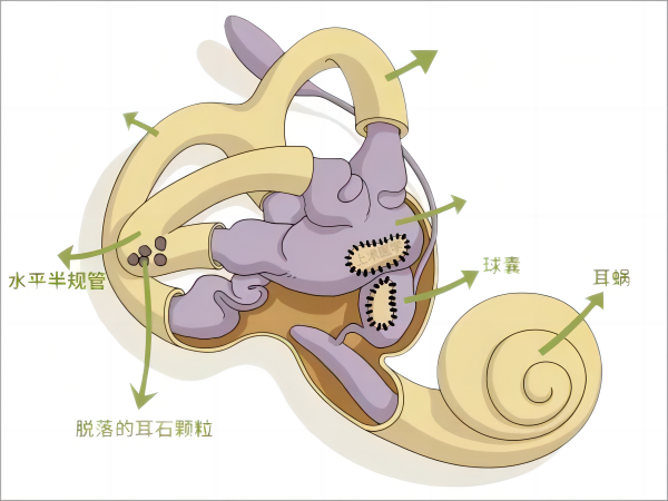 耳石症(1)(1).png
